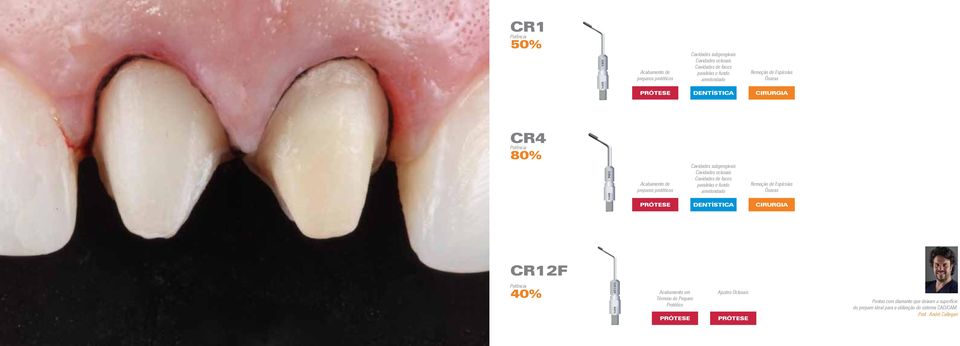 paralelas e fundo arredondado Remoção de Espícolas Ósseas PRÓTESE CIRURGIA CR12F 40% Acabamento em Término de Preparo Protético PRÓTESE