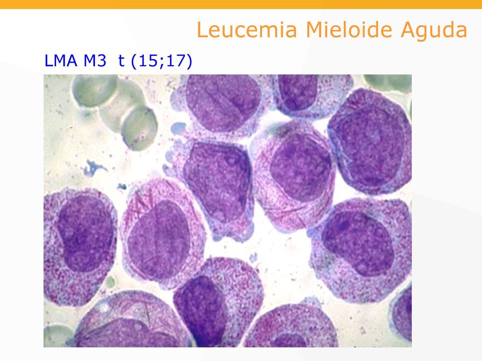 Leucemia