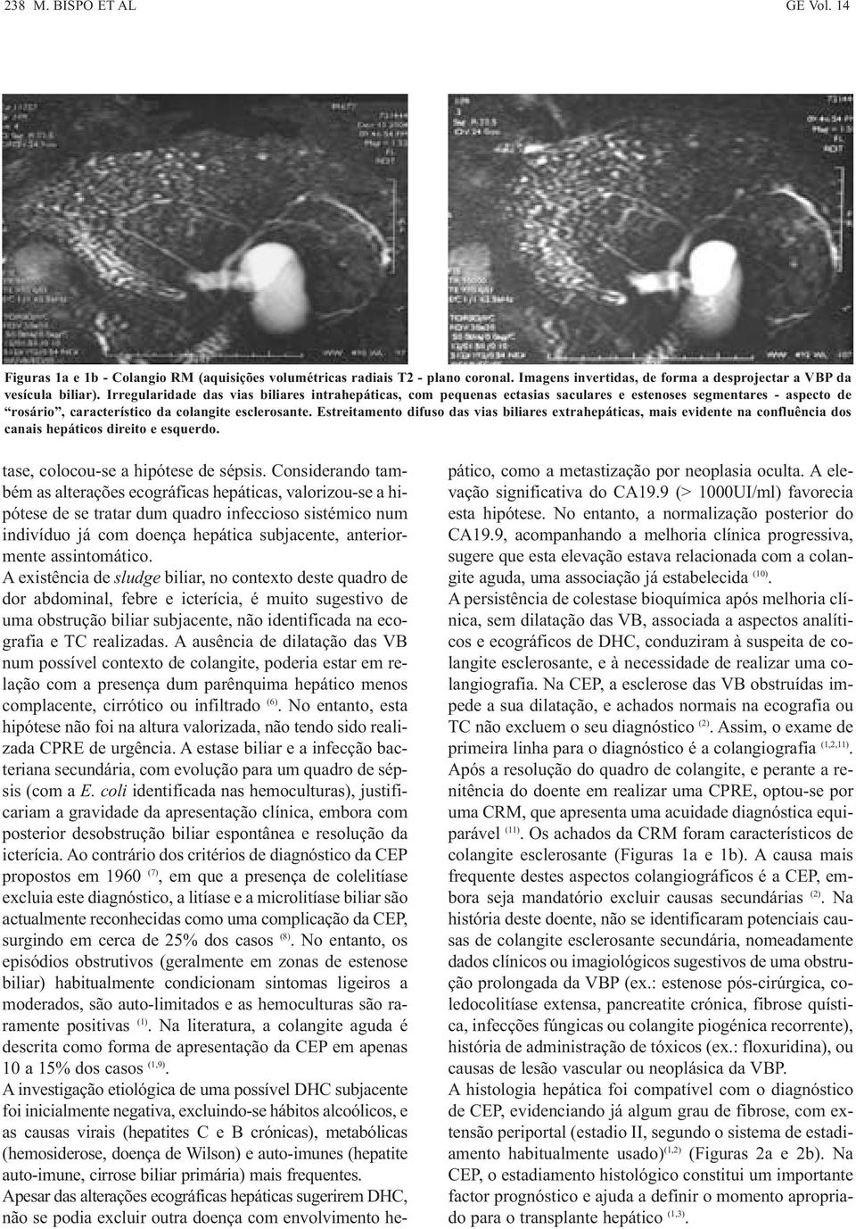 Estreitamento difuso das vias biliares extrahepáticas, mais evidente na confluência dos canais hepáticos direito e esquerdo. tase, colocou-se a hipótese de sépsis.