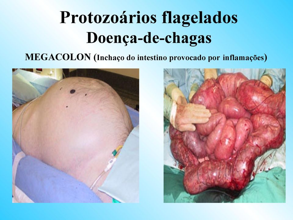 MEGACOLON (Inchaço do