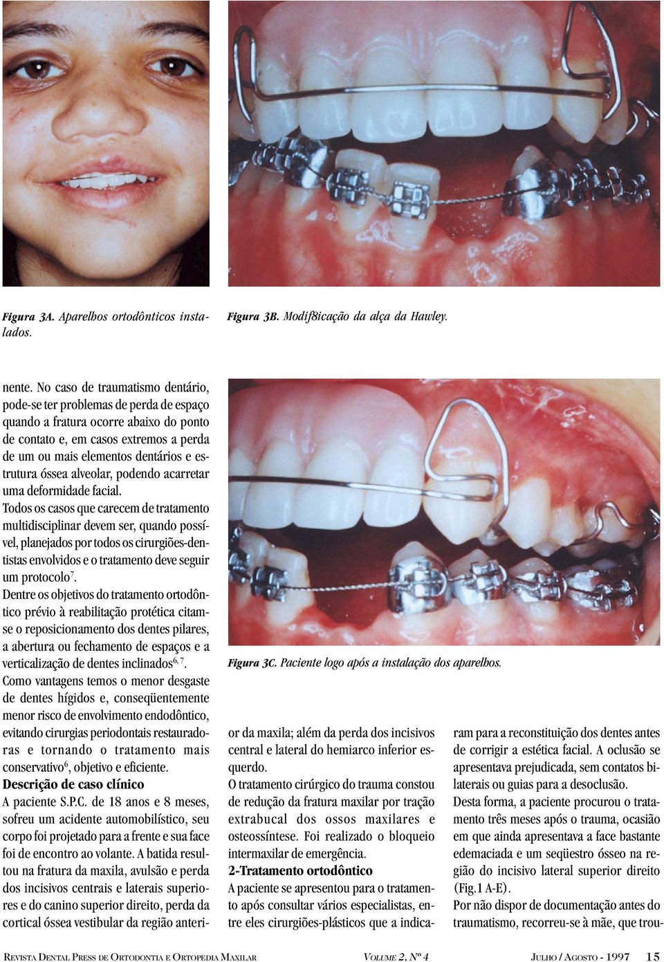 óssea alveolar, podendo acarretar uma deformidade facial.