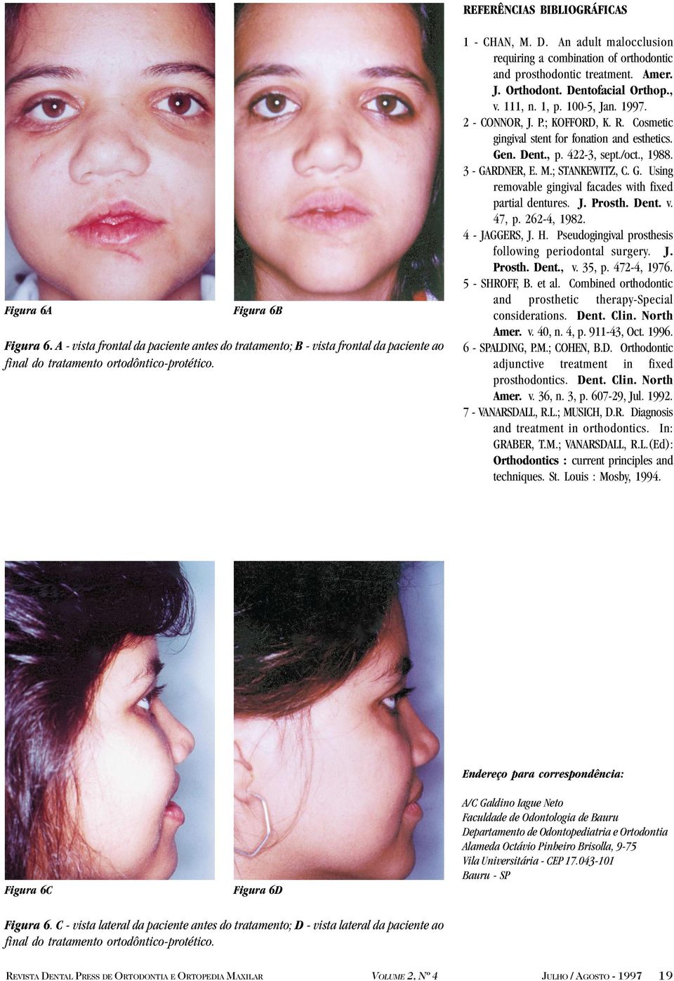 Cosmetic gingival stent for fonation and esthetics. Gen. Dent., p. 422-3, sept./oct., 1988. 3 - GARDNER, E. M.; STANKEWITZ, C. G. Using removable gingival facades with fixed partial dentures. J.