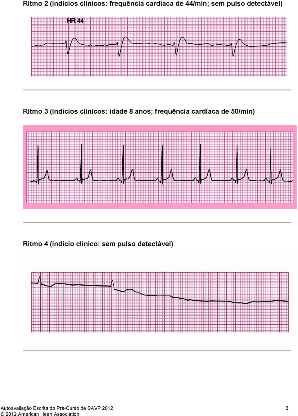 frequência cardíaca de 50/min) Ritmo 4 (indício clínico: sem