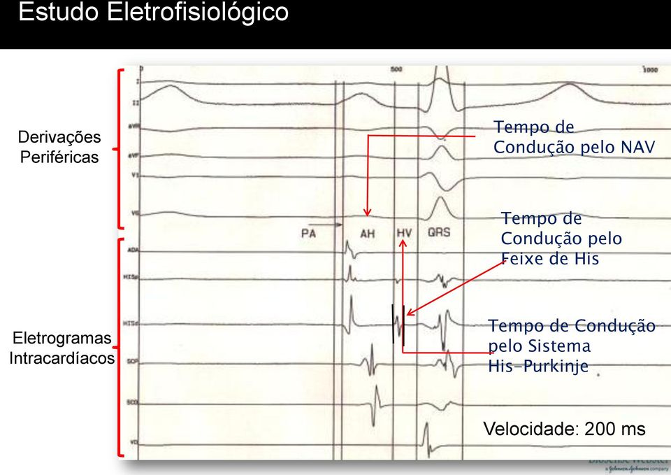 Feixe de His Eletrogramas Intracardíacos Tempo de