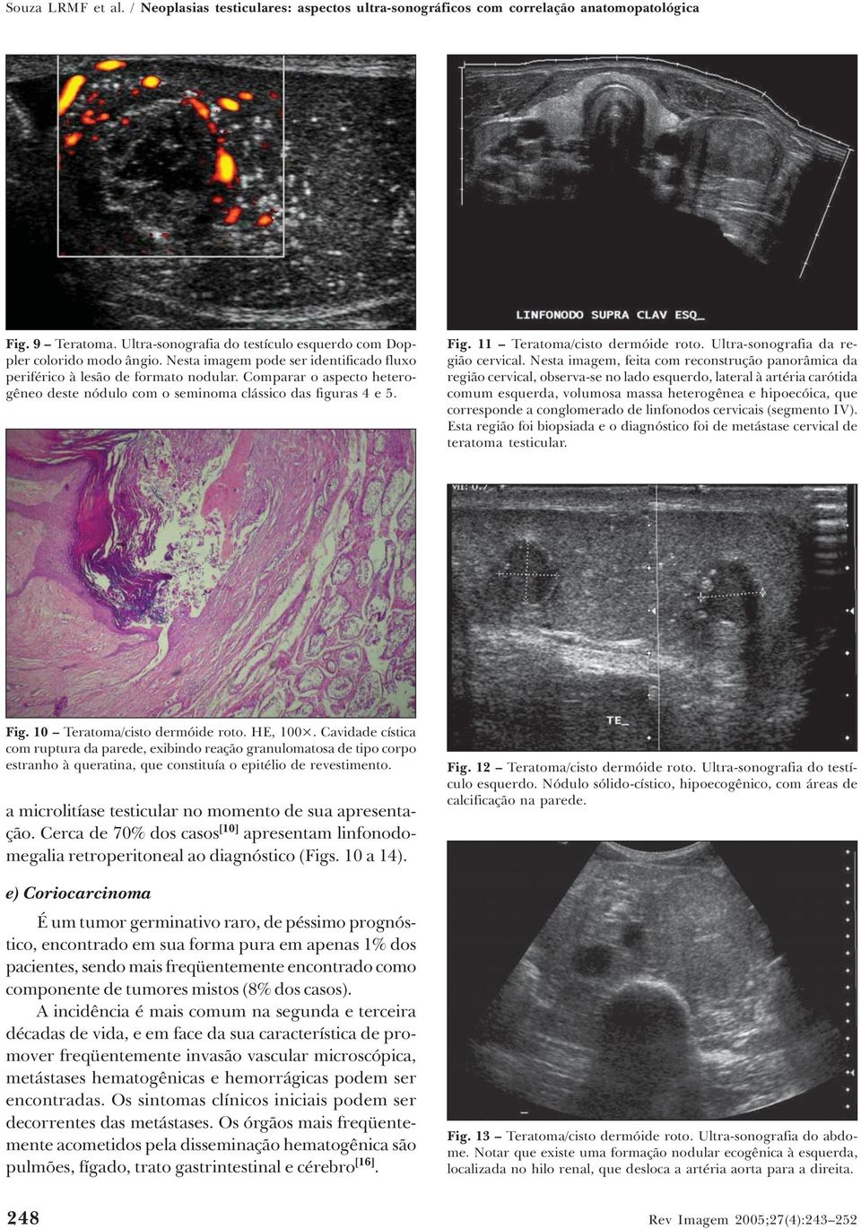 11 Teratoma/cisto dermóide roto. Ultra-sonografia da região cervical.