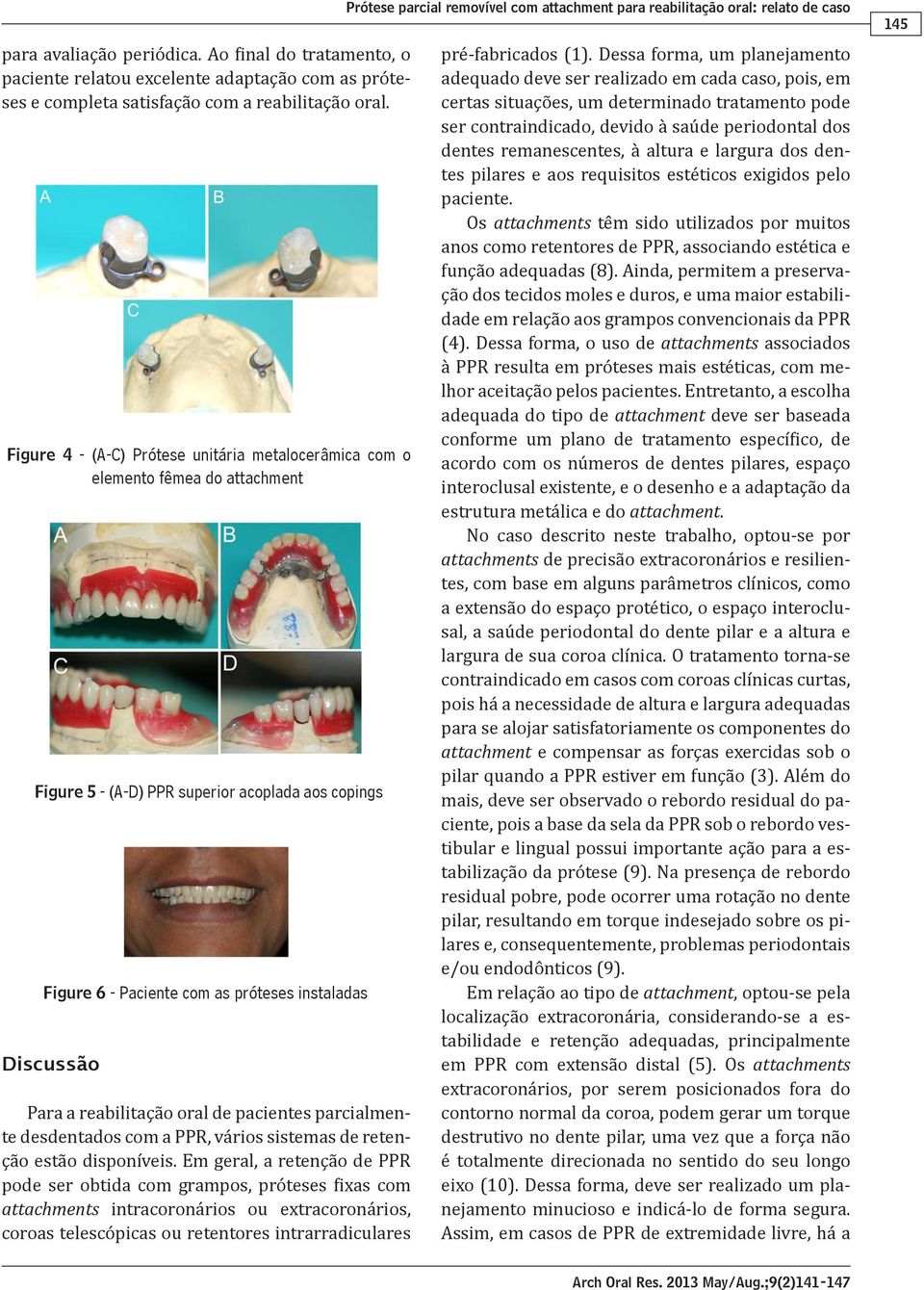 reabilitação oral de pacientes parcialmente desdentados com a PPR, vários sistemas de retenção estão disponíveis.