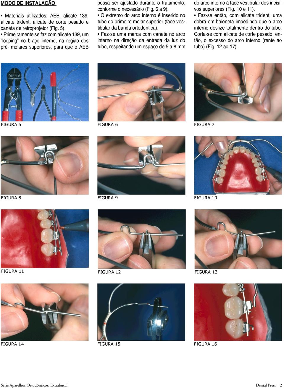 O extremo do arco interno é inserido no tubo do primeiro molar superior (face vestibular da banda ortodôntica).