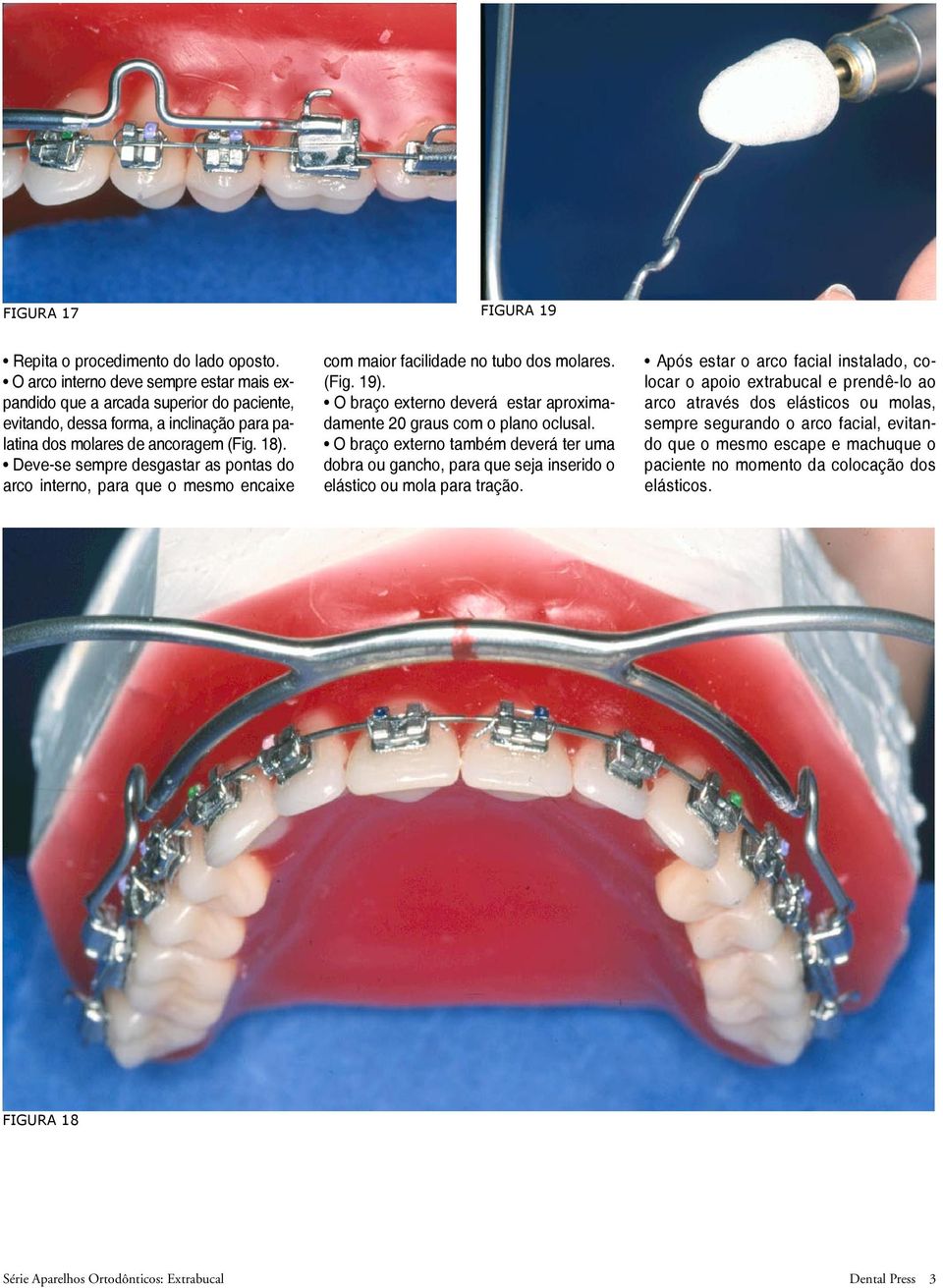 Deve-se sempre desgastar as pontas do arco interno, para que o mesmo encaixe com maior facilidade no tubo dos molares. (Fig. 19).