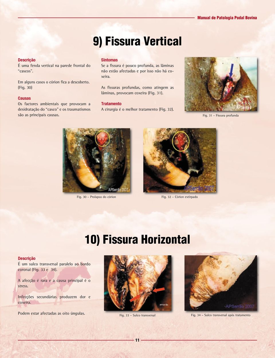 As fissuras profundas, como atingem as lâminas, provocam coxeira (Fig. 31). A cirurgia é o melhor tratamento (Fig. 32). Fig. 31 Fissura profunda Fig. 30 Prolapso do córion Fig.