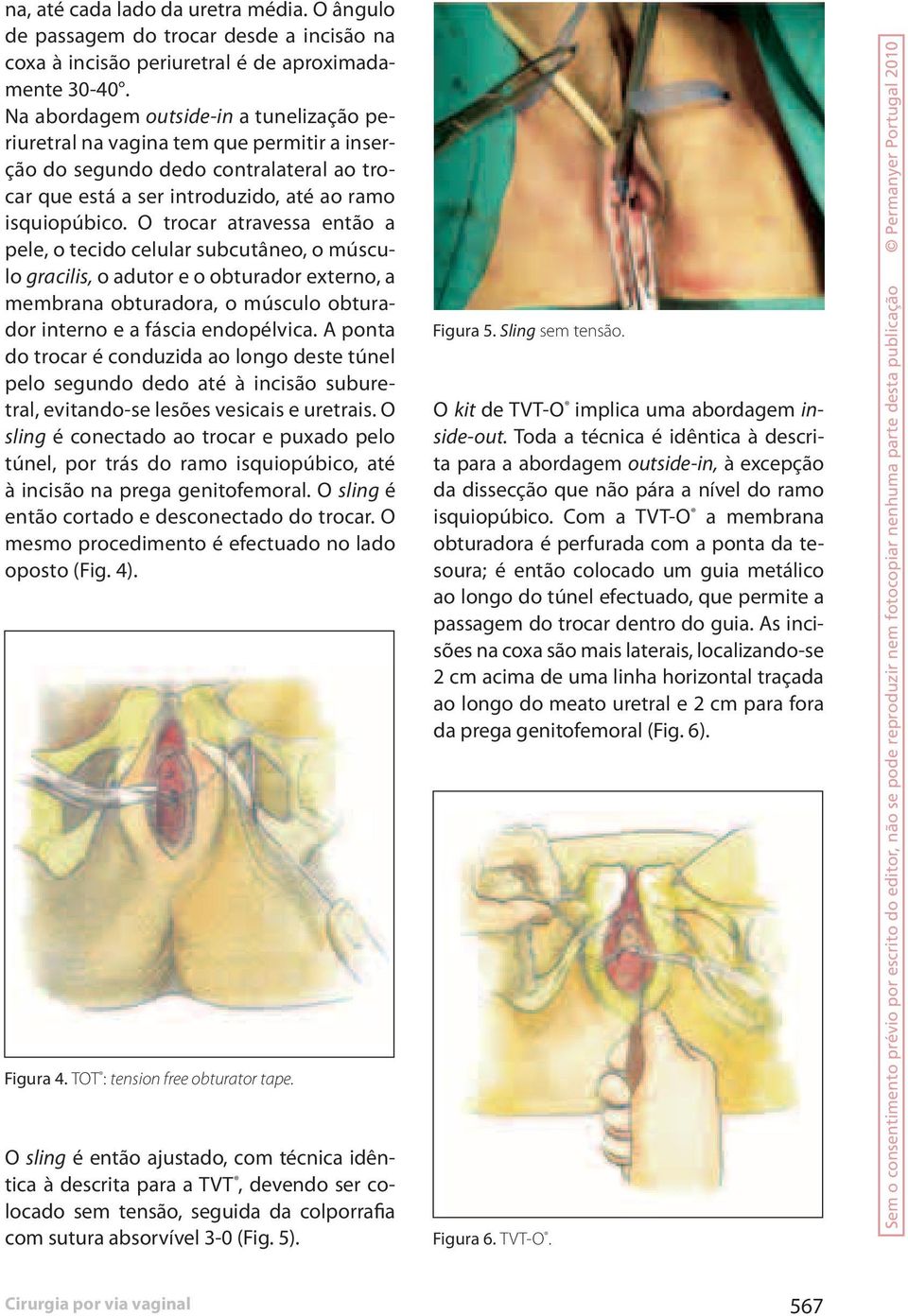 O trocar atravessa então a pele, o tecido celular subcutâneo, o músculo gracilis, o adutor e o obturador externo, a membrana obturadora, o músculo obturador interno e a fáscia endopélvica.