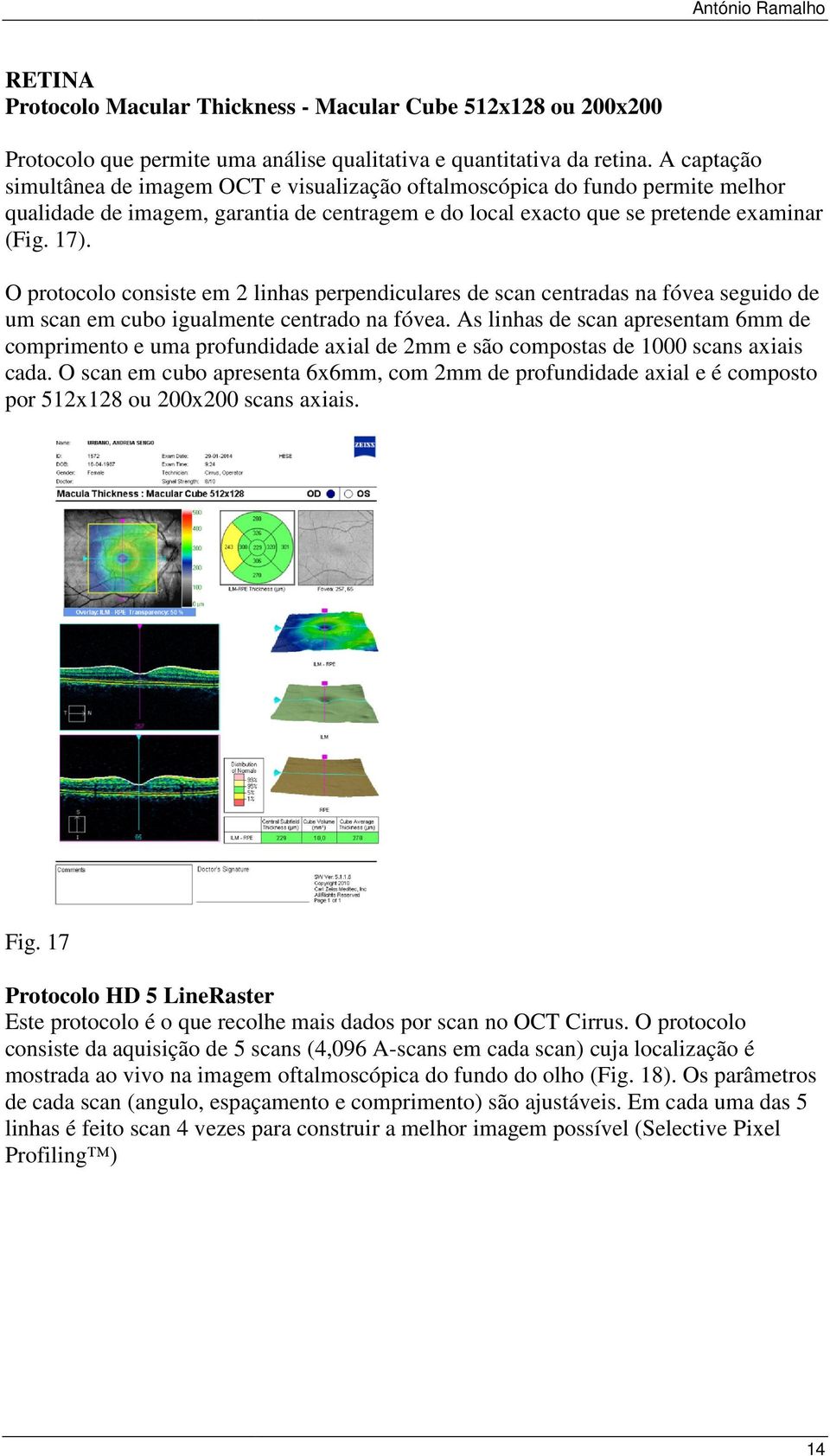 O protocolo consiste em 2 linhas perpendiculares de scan centradas na fóvea seguido de um scan em cubo igualmente centrado na fóvea.