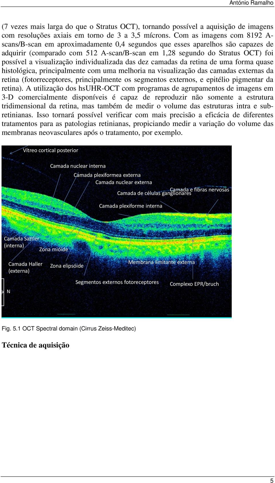 visualização individualizada das dez camadas da retina de uma forma quase histológica, principalmente com uma melhoria na visualização das camadas externas da retina (fotorreceptores, principalmente