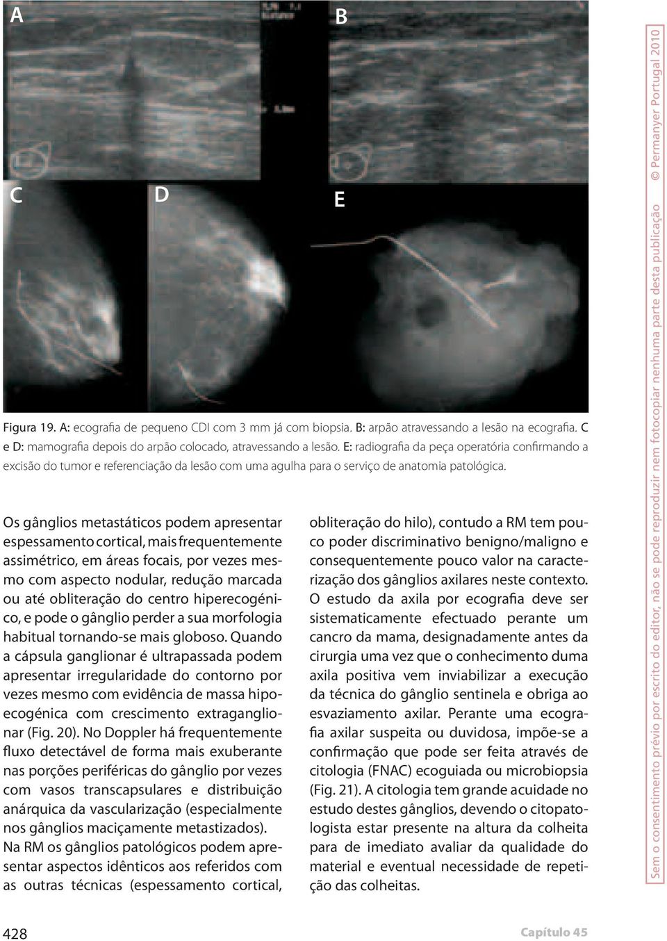 Os gânglios metastáticos podem apresentar espessamento cortical, mais frequentemente assimétrico, em áreas focais, por vezes mesmo com aspecto nodular, redução marcada ou até obliteração do centro