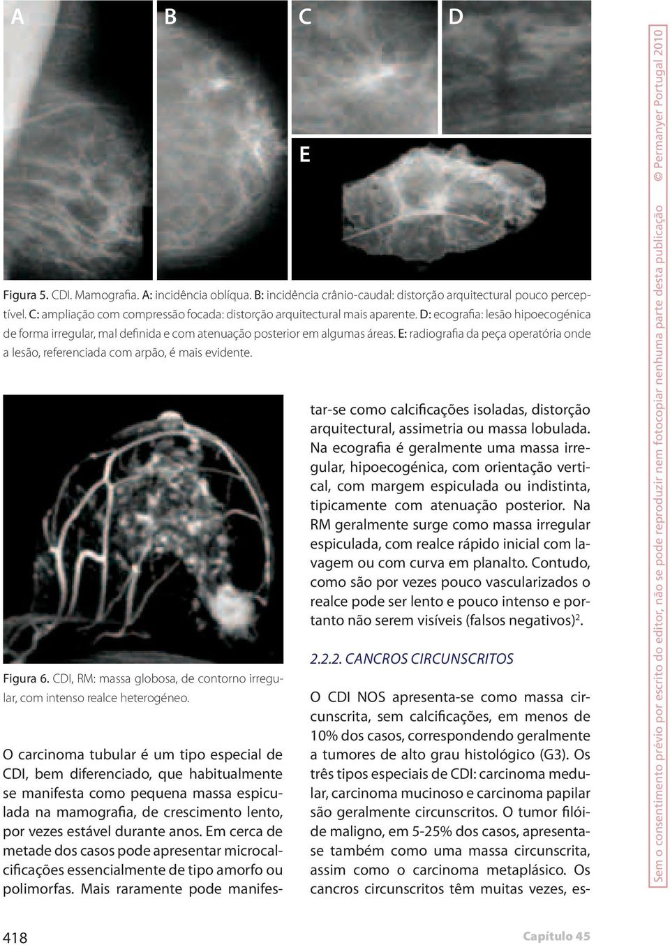 E: radiografia da peça operatória onde a lesão, referenciada com arpão, é mais evidente. Figura 6. CDI, RM: massa globosa, de contorno irregular, com intenso realce heterogéneo.