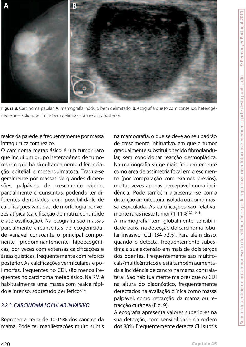 O carcinoma metaplásico é um tumor raro que inclui um grupo heterogéneo de tumores em que há simultaneamente diferenciação epitelial e mesenquimatosa.