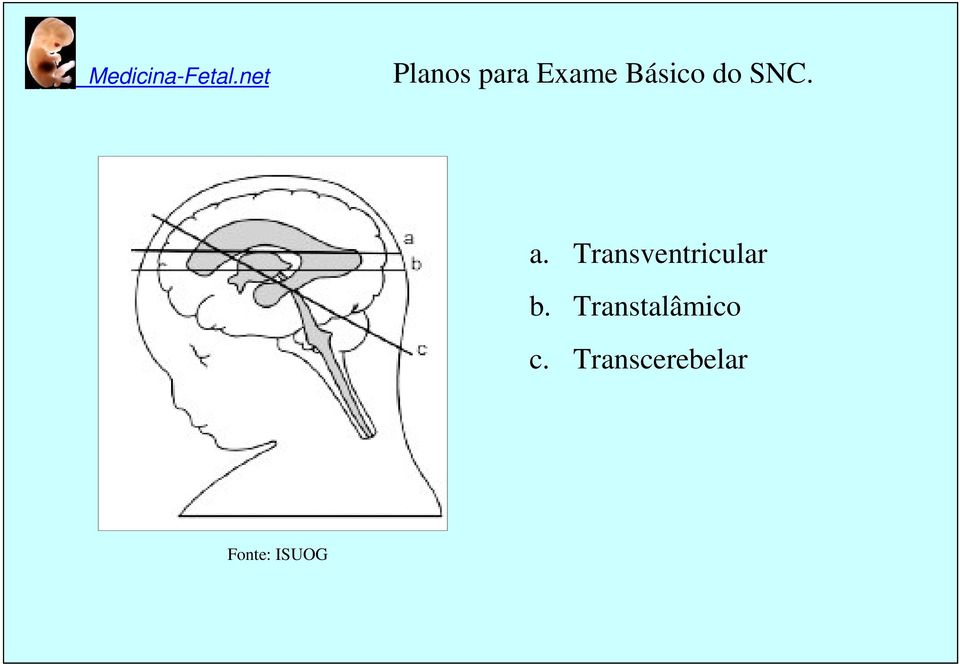 Transventricular b.