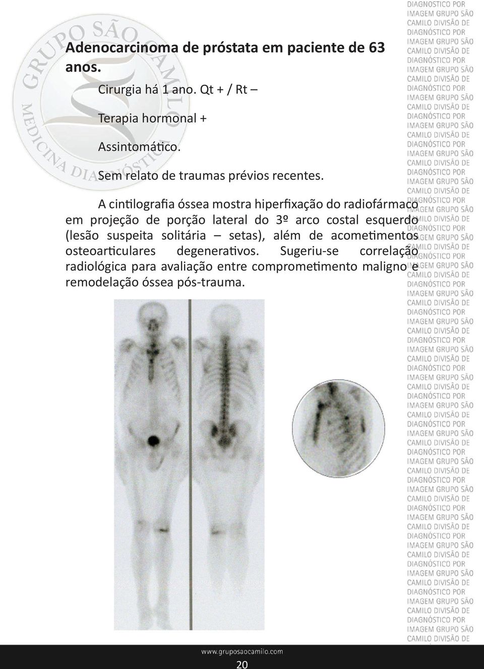 A cintilografia óssea mostra hiperfixação do radiofármaco em projeção de porção lateral do 3º arco costal esquerdo