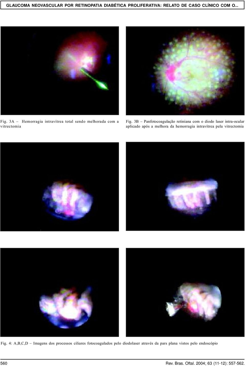 melhora da hemorragia intravítrea pela vitrectomia Fig.