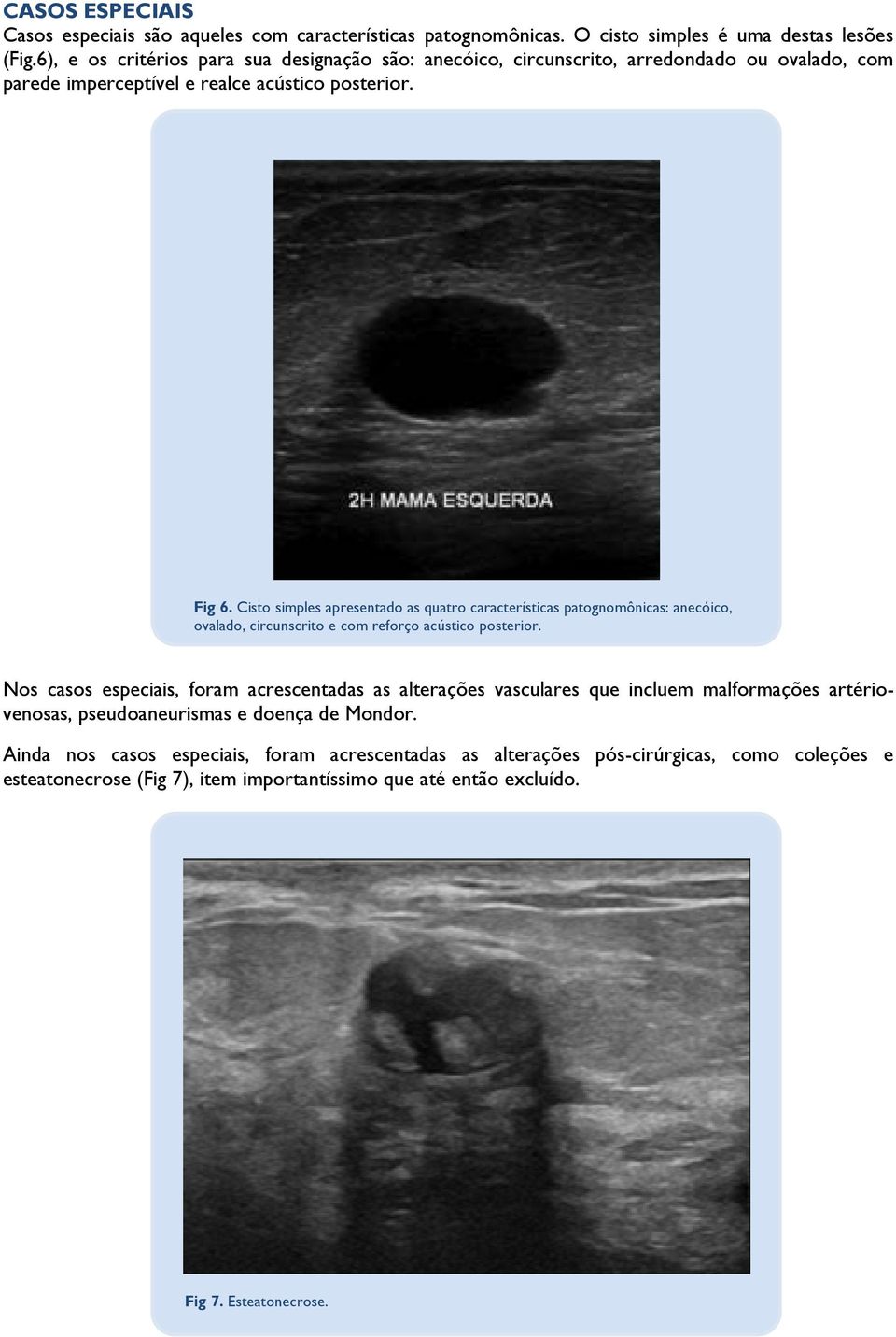 Cisto simples apresentado as quatro características patognomônicas: anecóico, ovalado, circunscrito e com reforço acústico posterior.