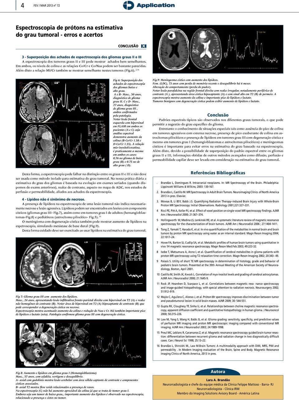 Além disto a relação Mi/Cr também se mostrar semelhante nestes tumores (Fig.6). 2,16 Fig 6: Superposição dos achados de espectroscopia dos gliomas baixo e alto grau. A e B- Masc.