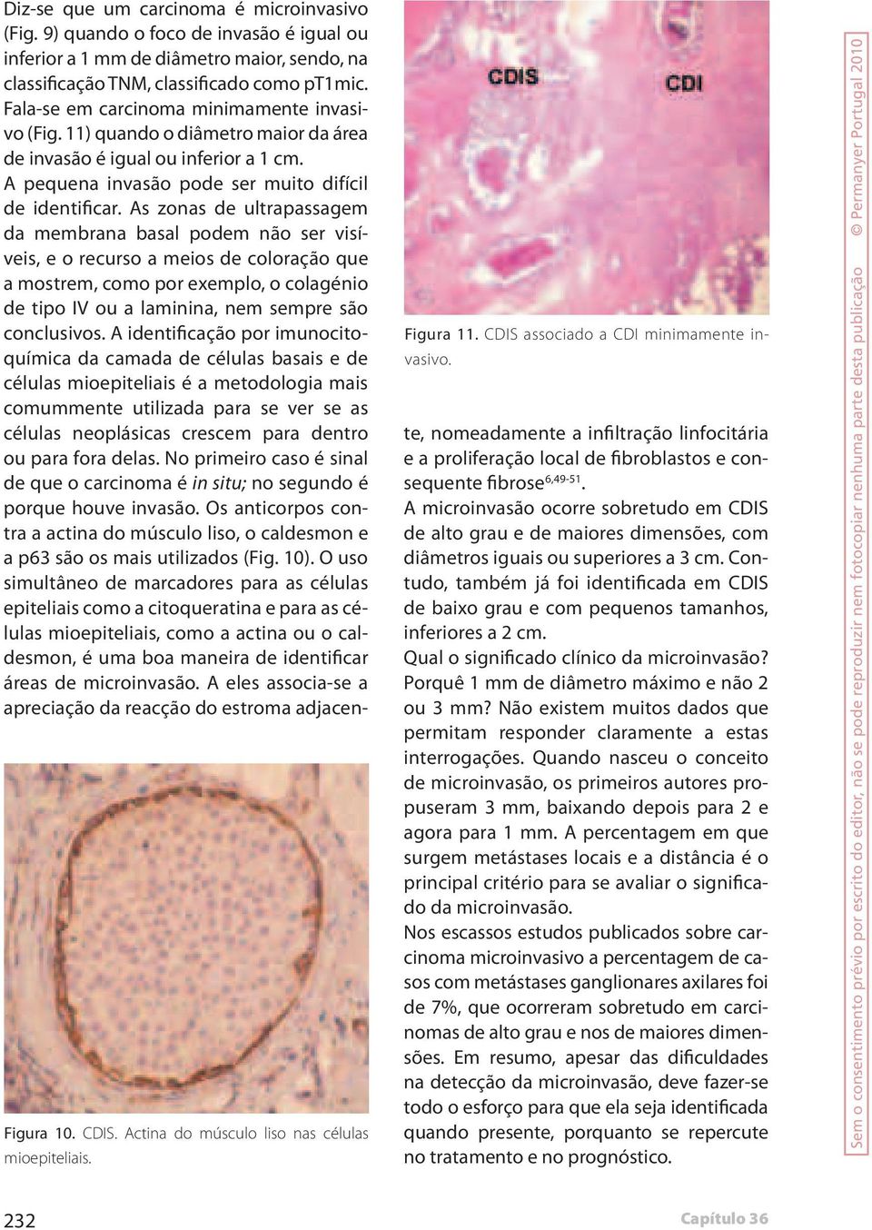 11) quando o diâmetro maior da área de invasão é igual ou inferior a 1 cm. A pequena invasão pode ser muito difícil de identificar.