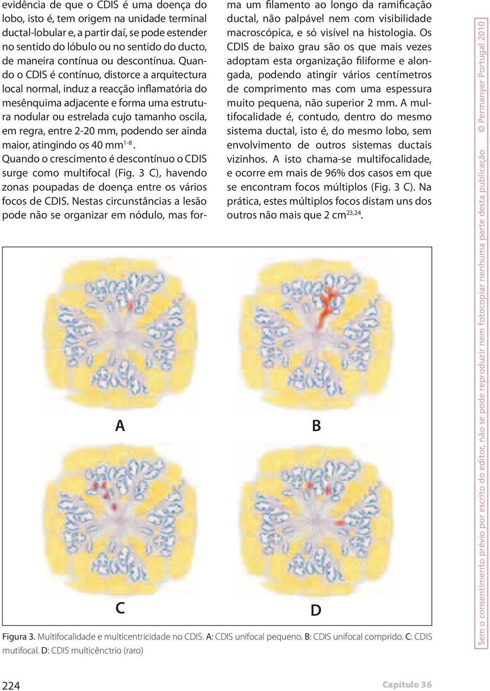 Quando o CDIS é contínuo, distorce a arquitectura local normal, induz a reacção inflamatória do mesênquima adjacente e forma uma estrutura nodular ou estrelada cujo tamanho oscila, em regra, entre