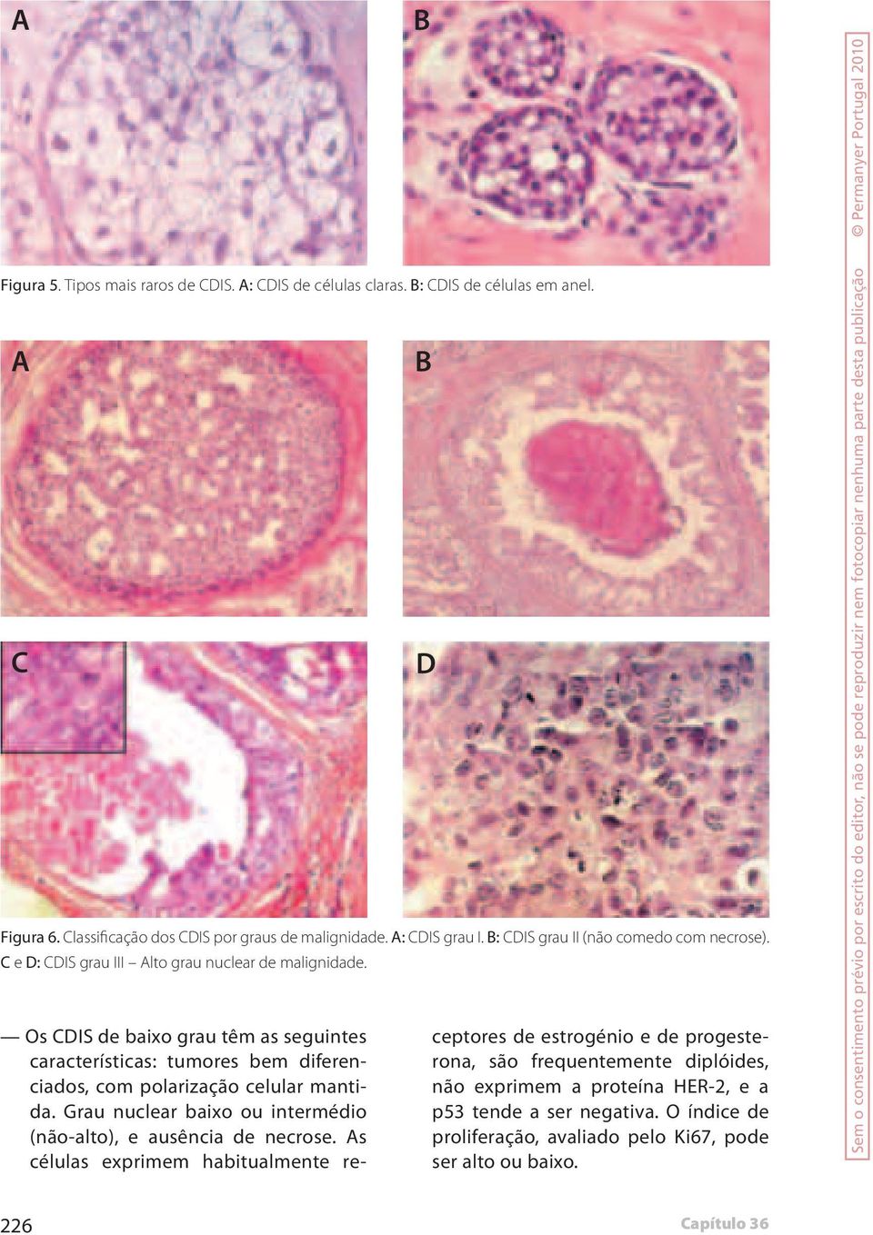 B B D Os CDIS de baixo grau têm as seguintes características: tumores bem diferenciados, com polarização celular mantida.
