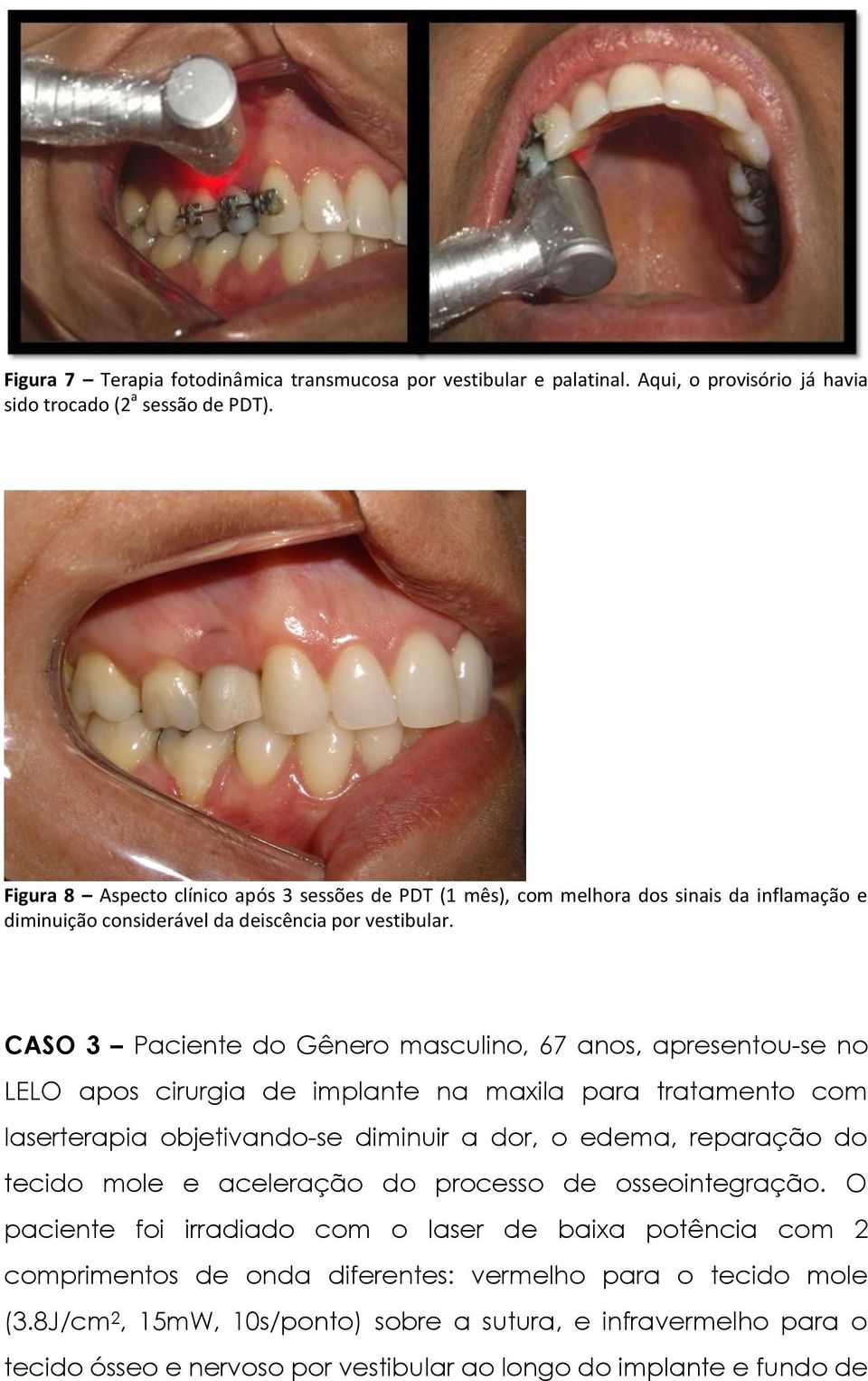 CASO 3 Paciente do Gênero masculino, 67 anos, apresentou-se no LELO apos cirurgia de implante na maxila para tratamento com laserterapia objetivando-se diminuir a dor, o edema, reparação do tecido