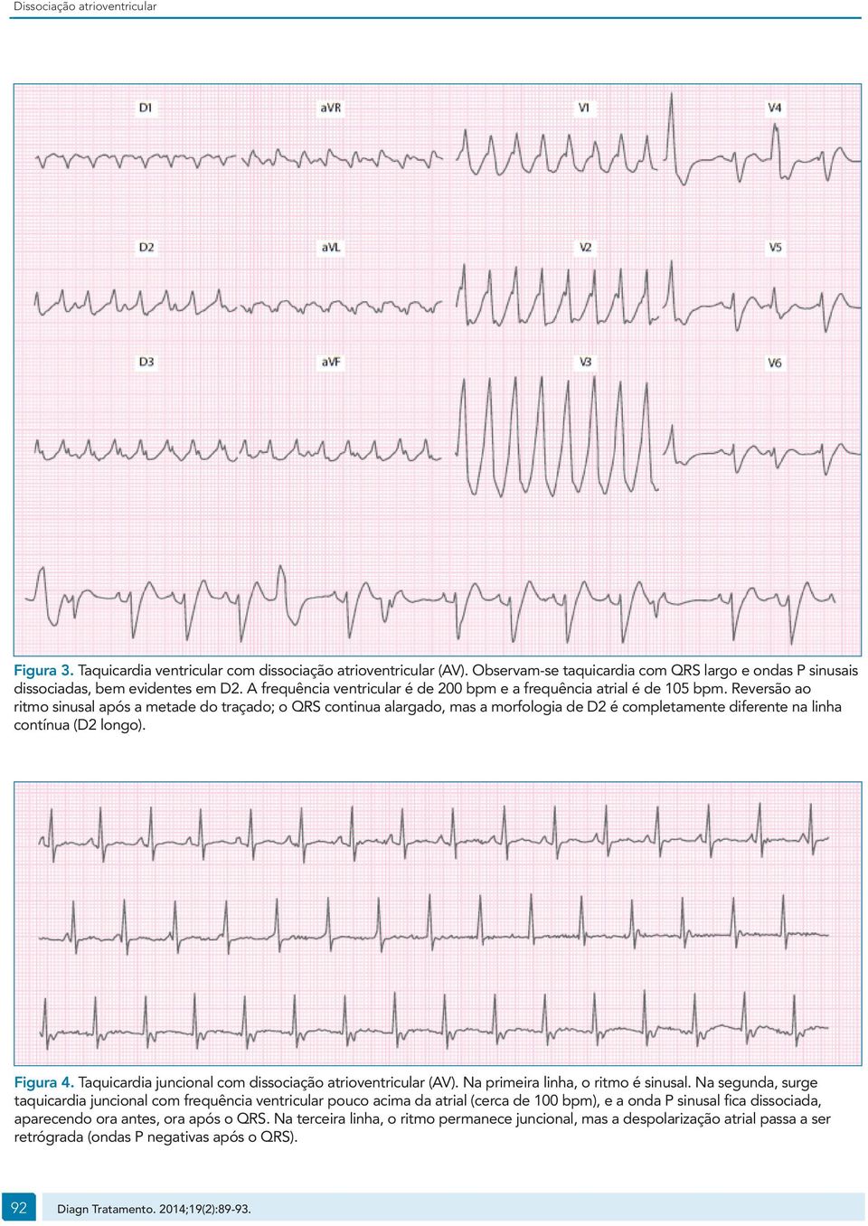 Reversão ao ritmo sinusal após a metade do traçado; o QRS continua alargado, mas a morfologia de D2 é completamente diferente na linha contínua (D2 longo). Figura 4.