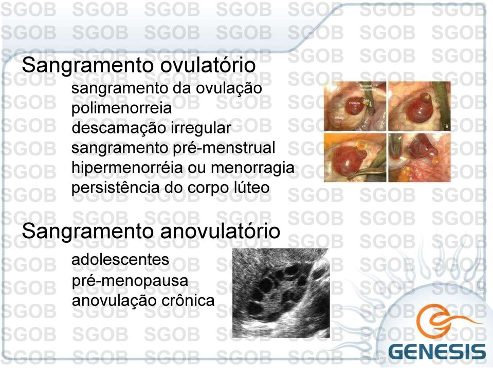 pré-menstrual hipermenorréia ou menorragia persistência do