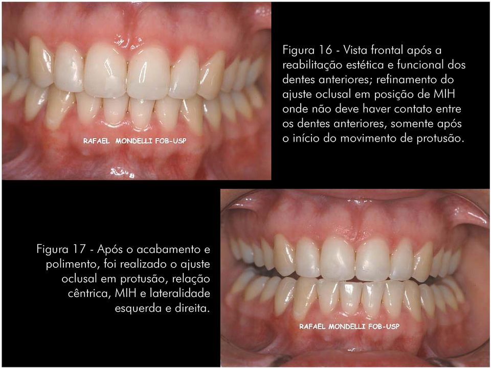 Figura 16 - Vista frontal após a reabilitação estética e funcional dos dentes anteriores;