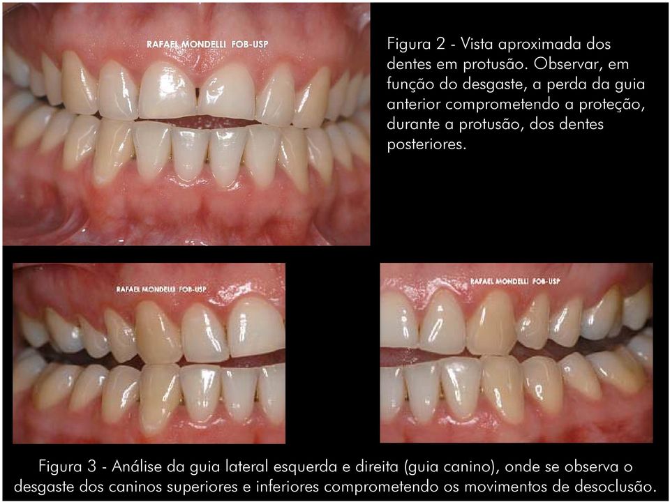 durante a protusão, dos dentes posteriores.