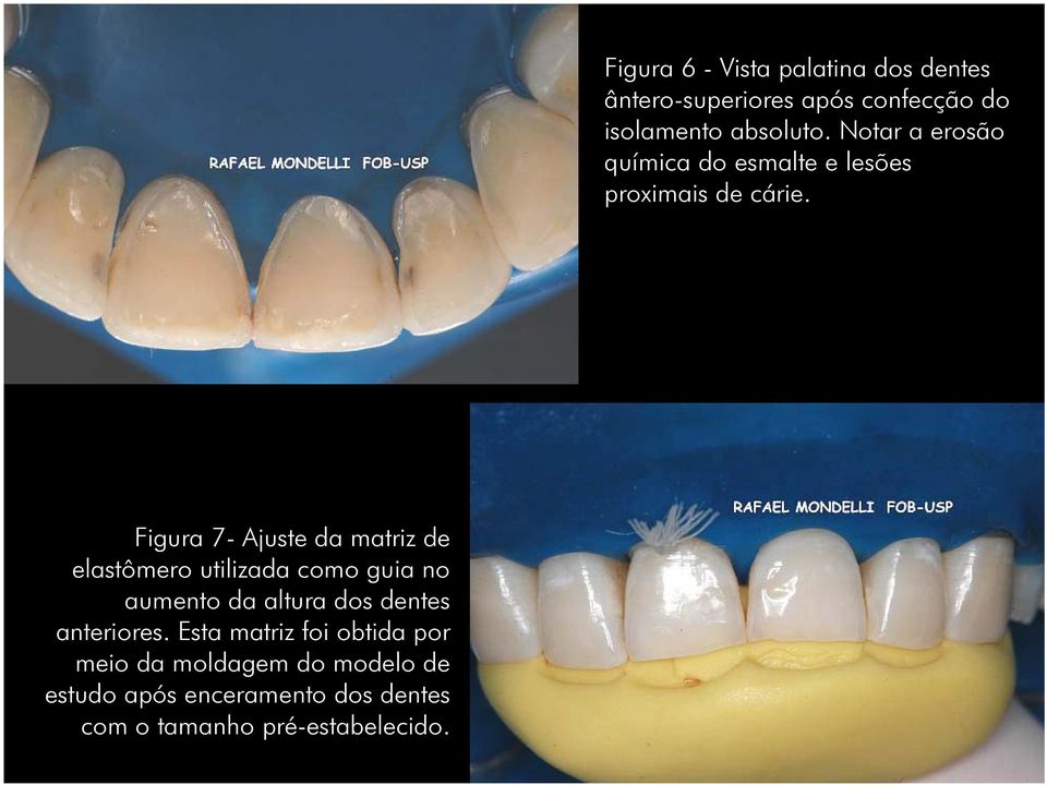 Esta matriz foi obtida por meio da moldagem do modelo de estudo após enceramento dos dentes com