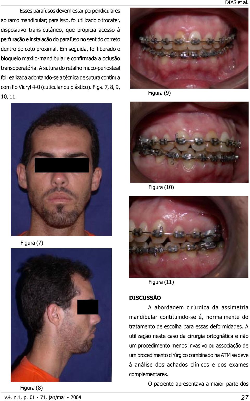 A sutura do retalho muco-periosteal foi realizada adontando-se a técnica de sutura contínua com fio Vicryl 4-0 (cuticular ou plástico). Figs. 7, 8, 9, 10, 11. Figura (9) DIAS et al.