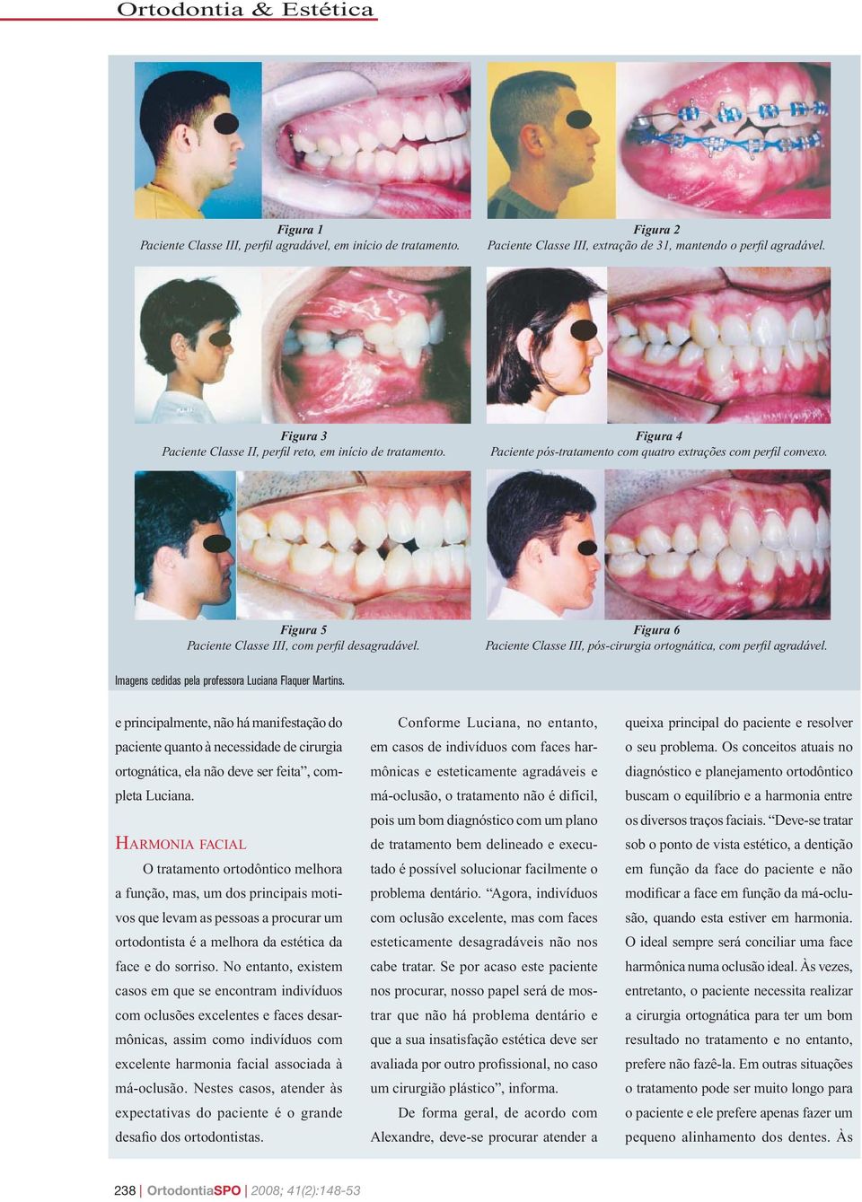 Figura 6 Paciente Classe III, pós-cirurgia ortognática, com perfil agradável. Imagens cedidas pela professora Luciana Flaquer Martins.