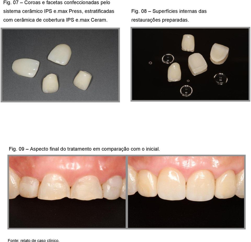 08 Superfícies internas das restaurações preparadas. Fig.