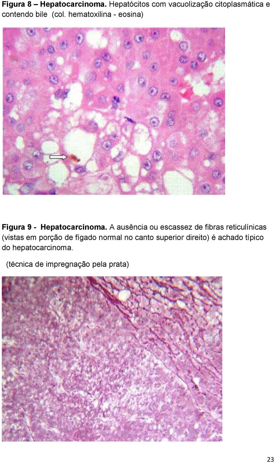 hematoxilina - eosina) Figura 9 - Hepatocarcinoma.