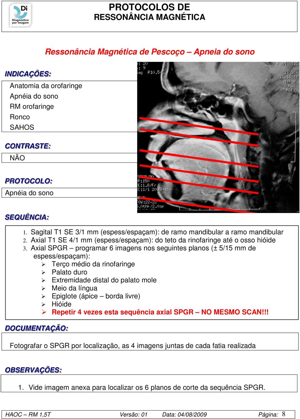 Axial SPGR programar 6 imagens nos seguintes planos (± 5/15 mm de espess/espaçam): Terço médio da rinofaringe Palato duro Extremidade distal do palato mole Meio da língua Epiglote (ápice borda livre)