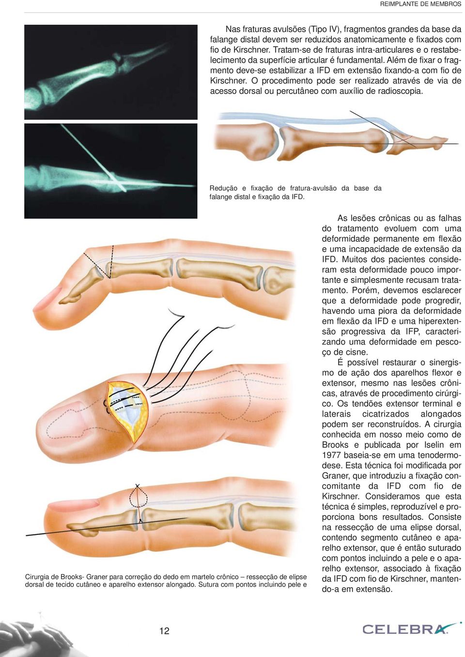 O procedimento pode ser realizado através de via de acesso dorsal ou percutâneo com auxílio de radioscopia. Redução e fixação de fratura-avulsão da base da falange distal e fixação da IFD.