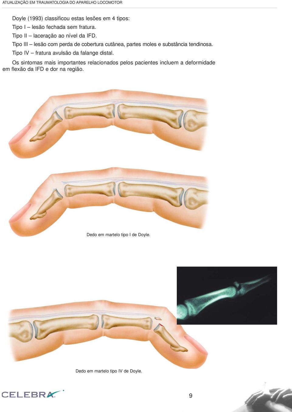 Tipo III lesão com perda de cobertura cutânea, partes moles e substância tendinosa.