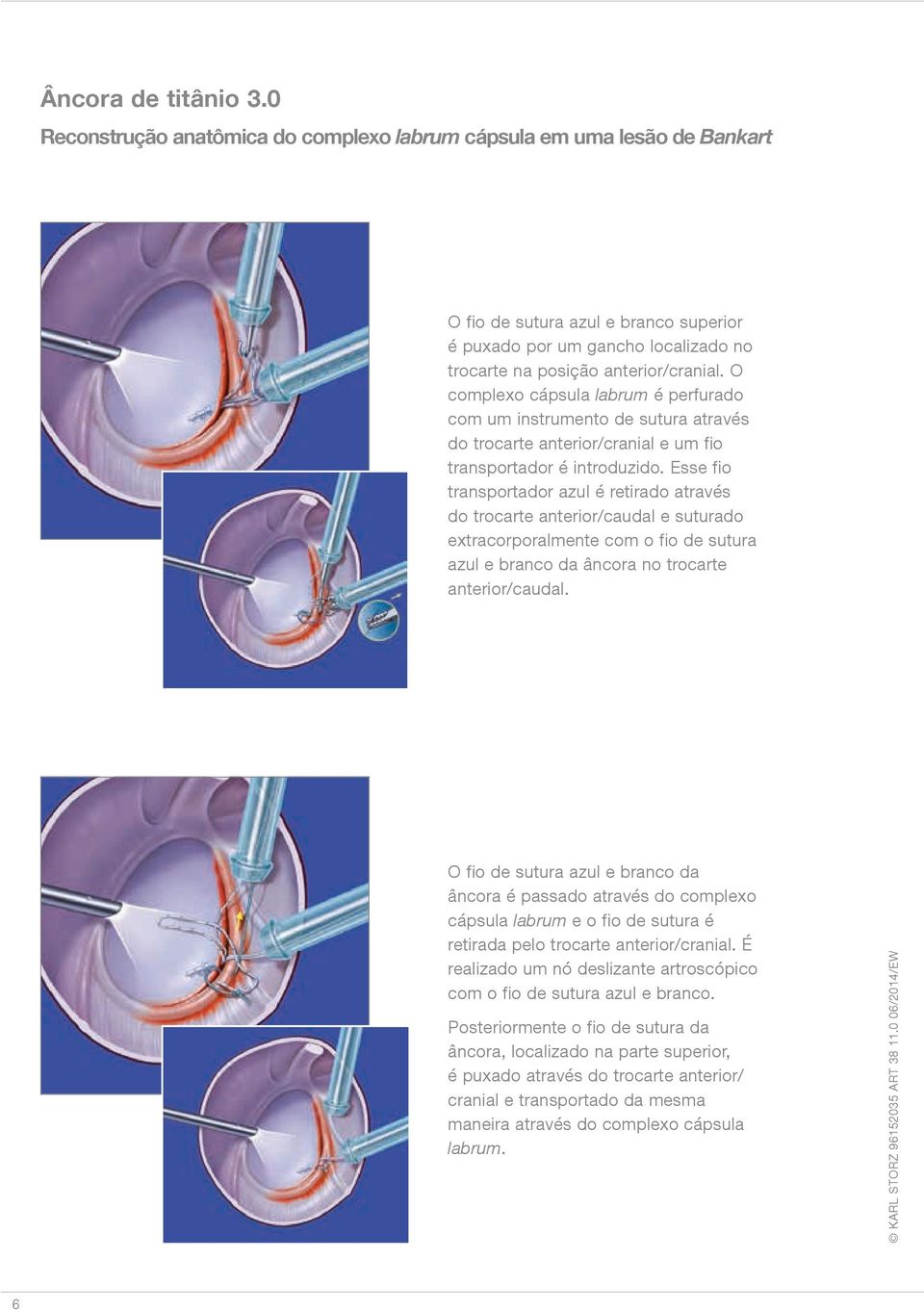 O complexo cápsula labrum é perfurado com um instrumento de sutura através do trocarte anterior/cranial e um fio transportador é introduzido.