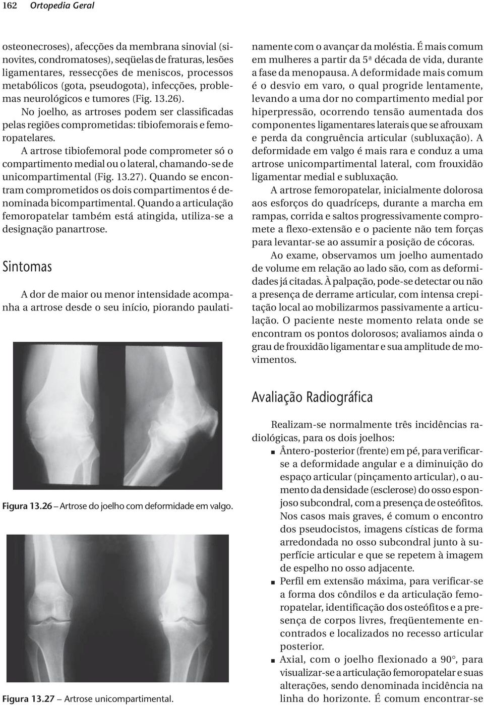 A artrose tibiofemoral pode comprometer só o compartimento medial ou o lateral, chamando-se de unicompartimental (Fig. 13.27).