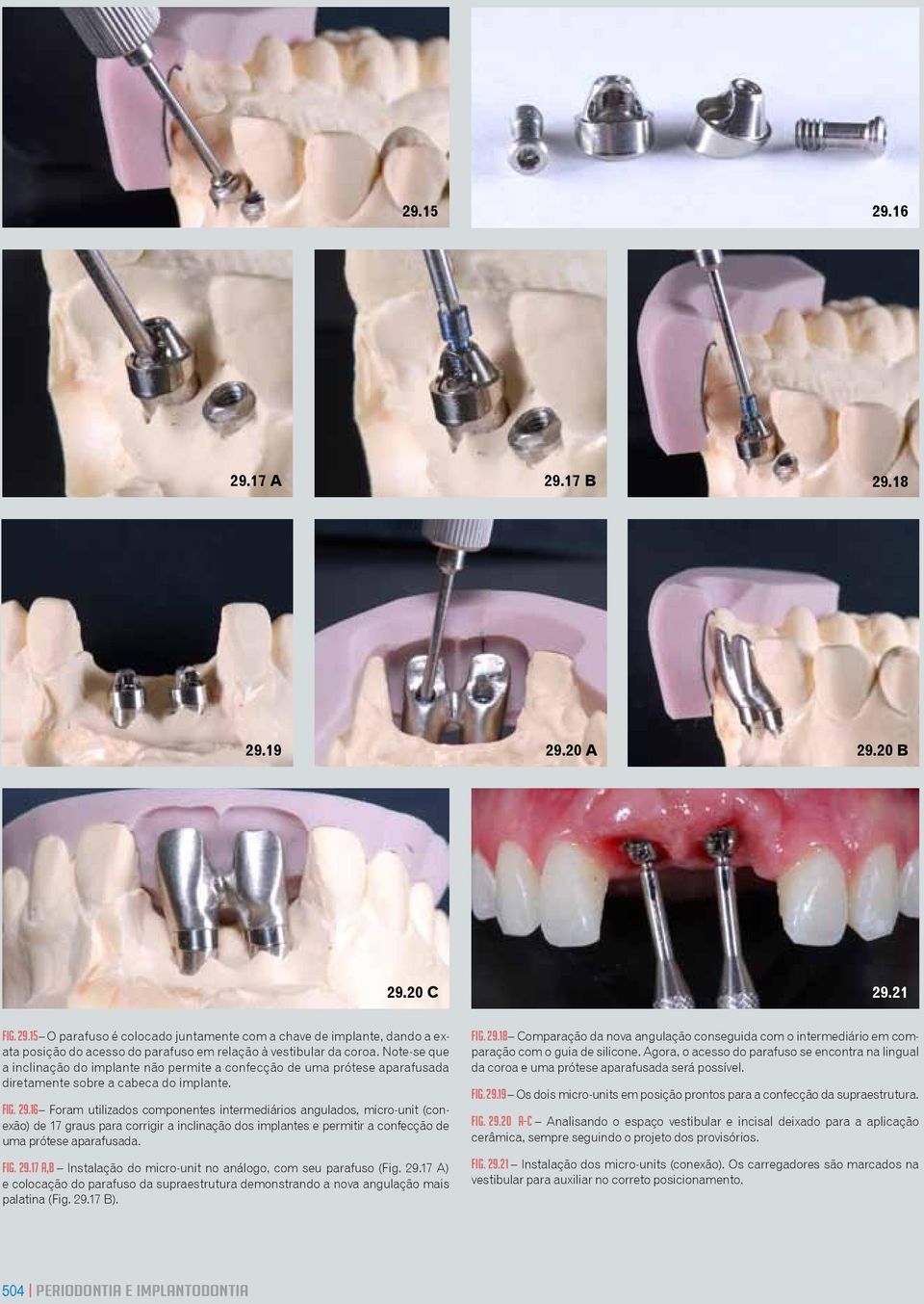 16 Foram utilizados componentes intermediários angulados, micro-unit (conexão) de 17 graus para corrigir a inclinação dos implantes e permitir a confecção de uma prótese aparafusada. fig. 29.