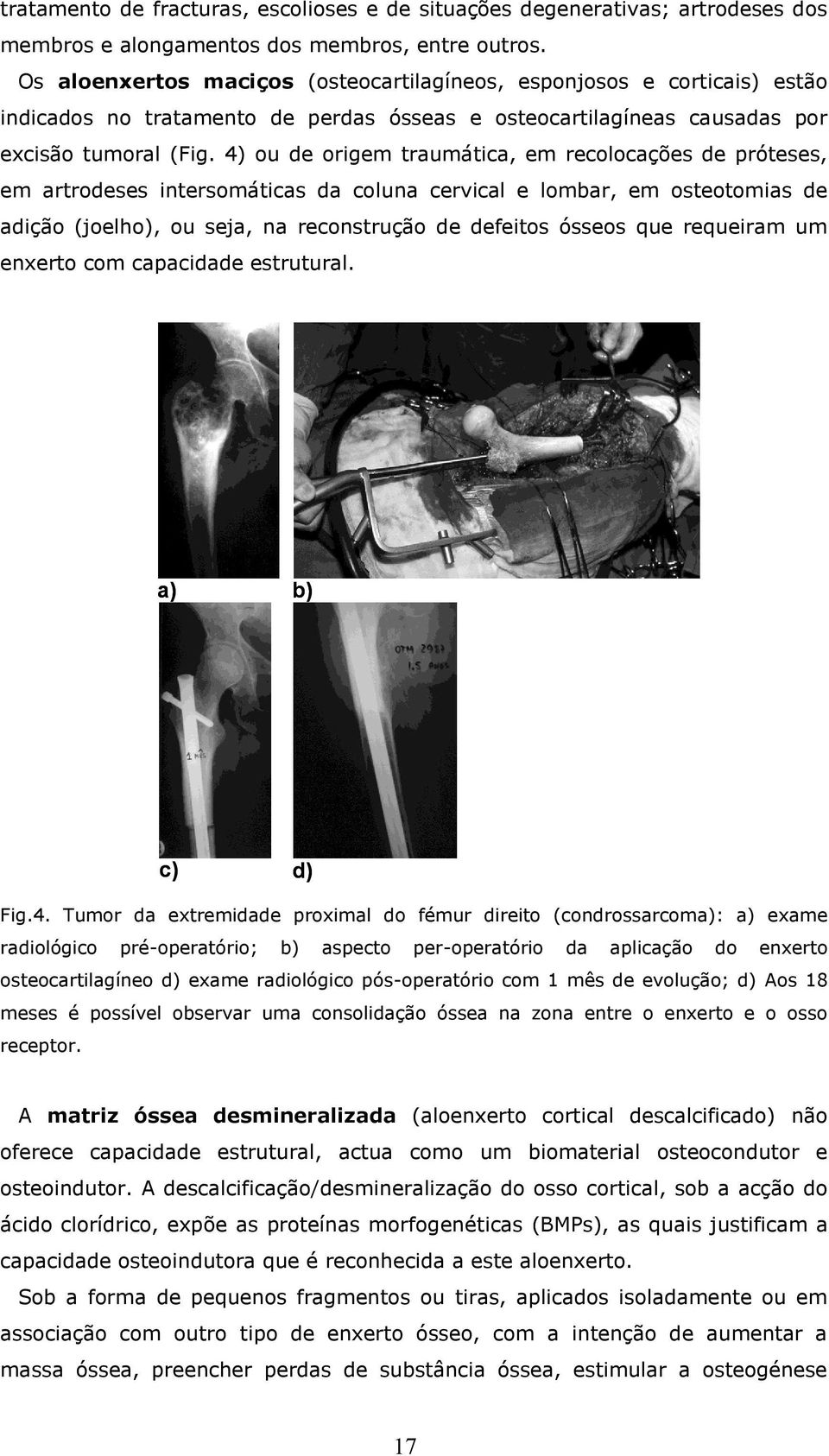 4) ou de origem traumática, em recolocações de próteses, em artrodeses intersomáticas da coluna cervical e lombar, em osteotomias de adição (joelho), ou seja, na reconstrução de defeitos ósseos que