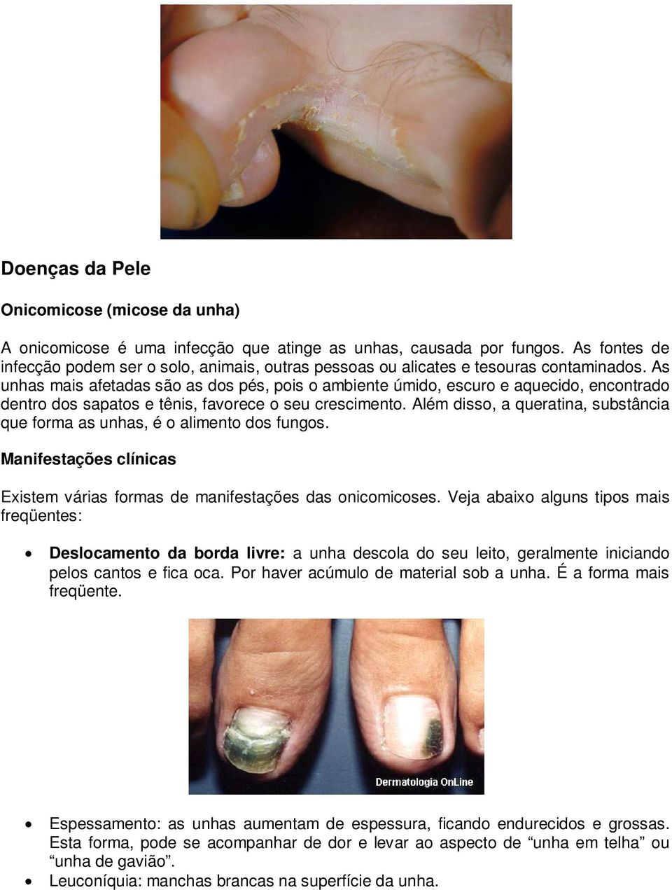 As unhas mais afetadas são as dos pés, pois o ambiente úmido, escuro e aquecido, encontrado dentro dos sapatos e tênis, favorece o seu crescimento.