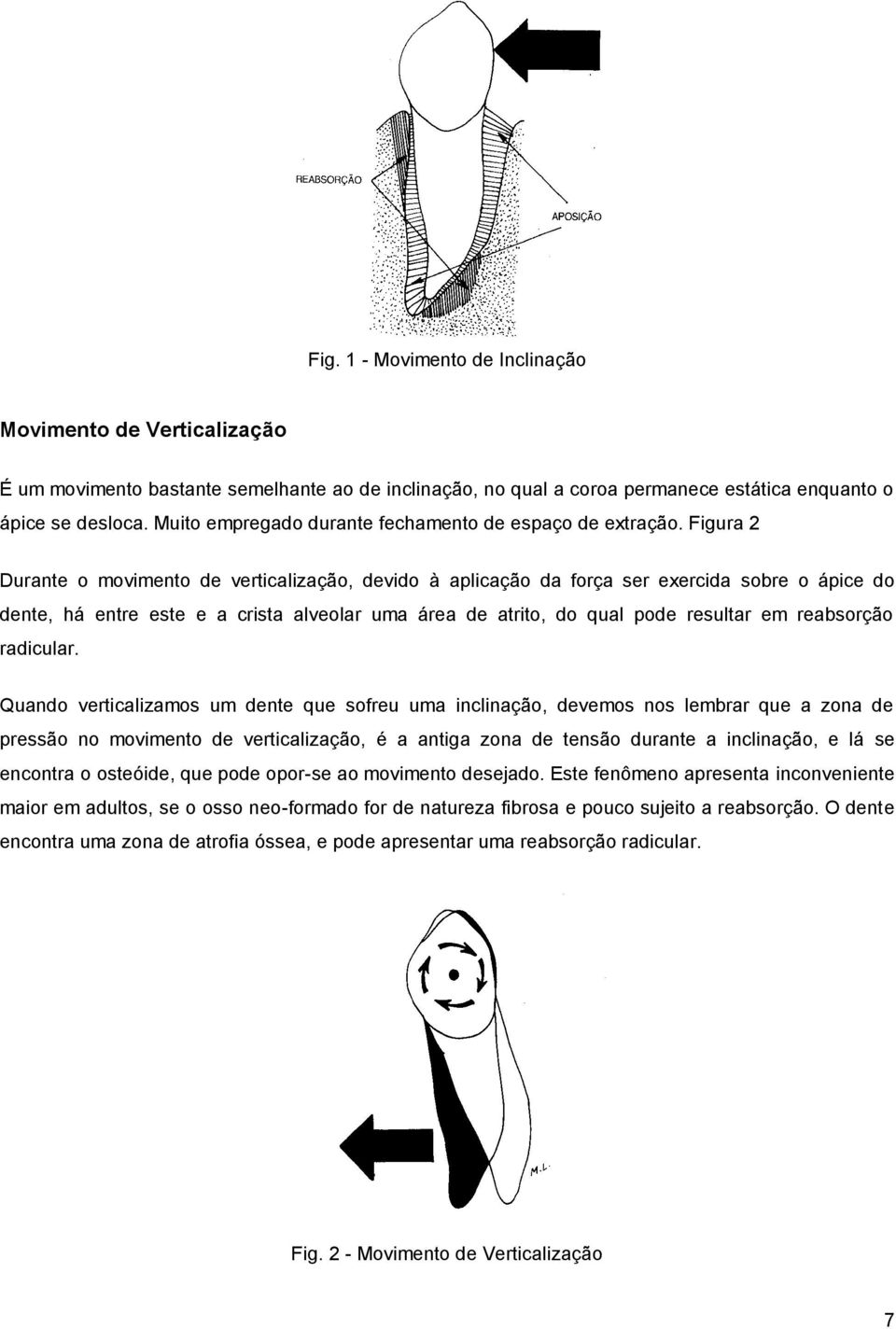 Figura 2 Durante o movimento de verticalização, devido à aplicação da força ser exercida sobre o ápice do dente, há entre este e a crista alveolar uma área de atrito, do qual pode resultar em