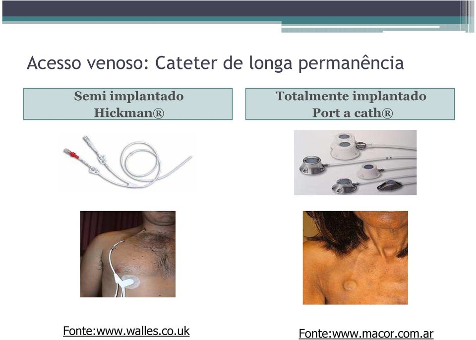 Totalmente implantado Port a cath