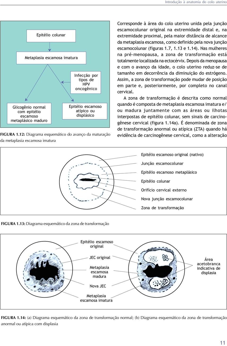 12: Diagrama esquemático do avanço da maturação da metaplasia escamosa imatura ˆ Corresponde à área do colo uterino unida pela junção escamocolunar original na extremidade distal e, na extremidade