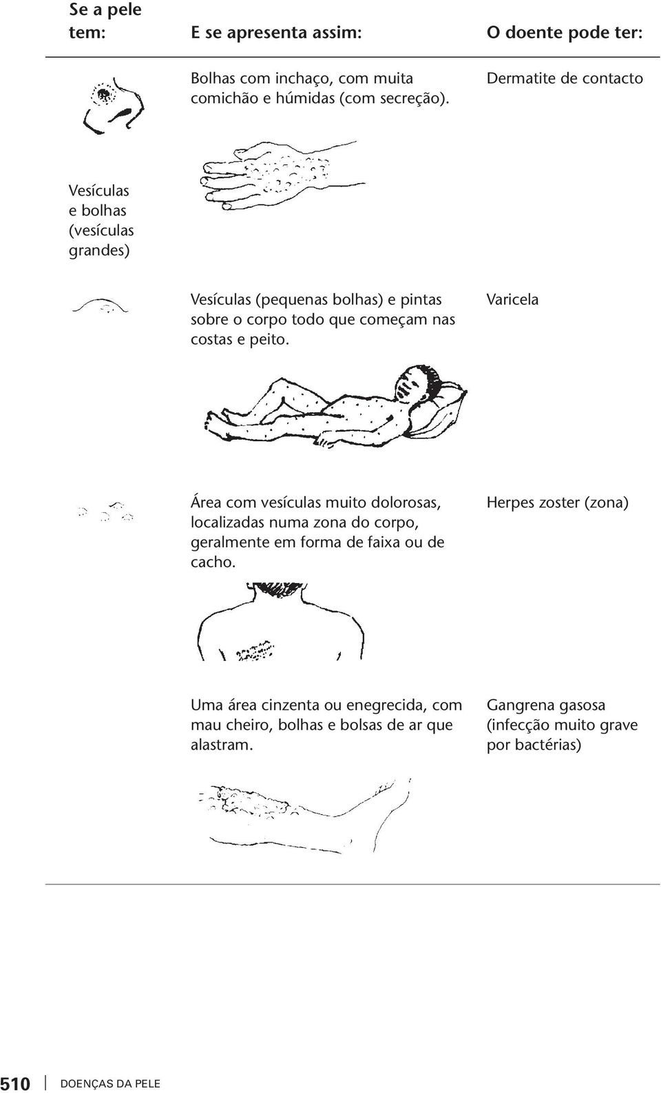 cosas e peio. Varicela Área com esículas muio dolorosas, localiadas numa ona do corpo, geralmene em forma de faixa ou de cacho.