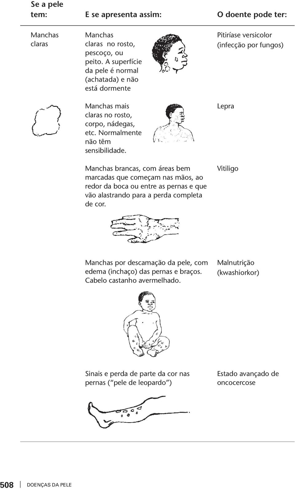 Manchas brancas, com áreas bem marcadas que começam nas mãos, ao redor da boca ou enre as pernas e que ão alasrando para a perda complea de cor.